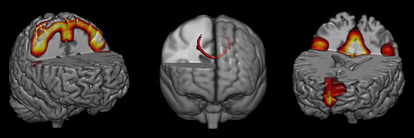 Imagem mostra a rede sensoriomotora (esquerda), de modo padrão (direita) e o corpo caloso (centro), que foram impactados positivamente pelo treinamento neurofeedback